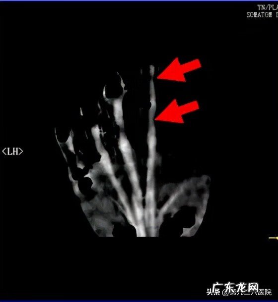 鬼影镰刀脚 镰刀割到脚怎么处理