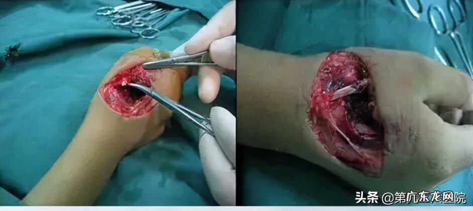 鬼影镰刀脚 镰刀割到脚怎么处理