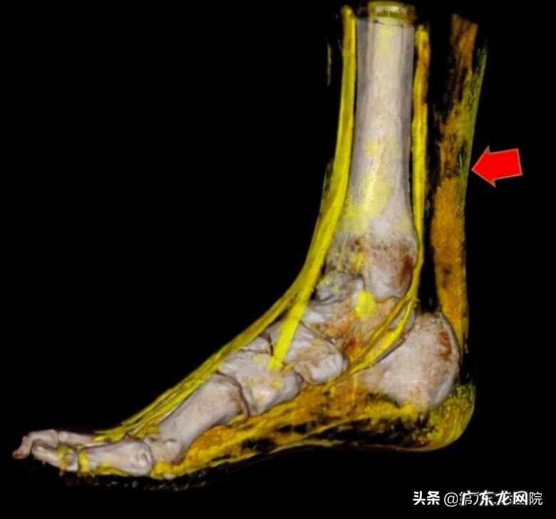 鬼影镰刀脚 镰刀割到脚怎么处理