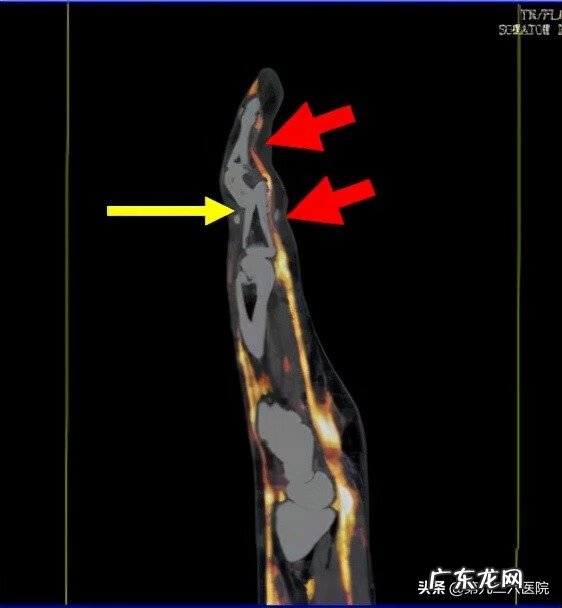鬼影镰刀脚 镰刀割到脚怎么处理