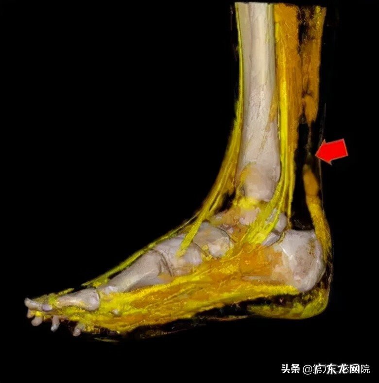 鬼影镰刀脚 镰刀割到脚怎么处理