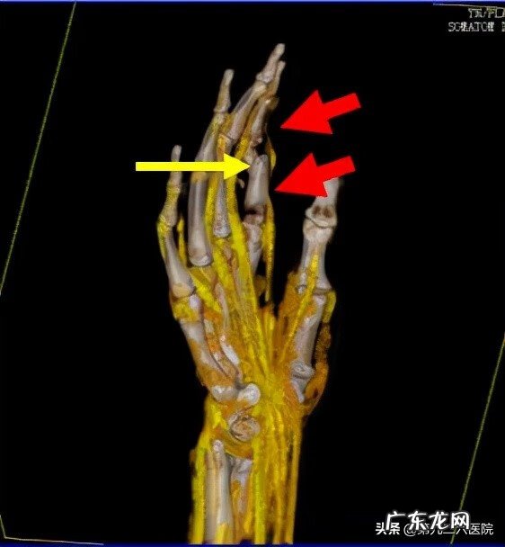 鬼影镰刀脚 镰刀割到脚怎么处理