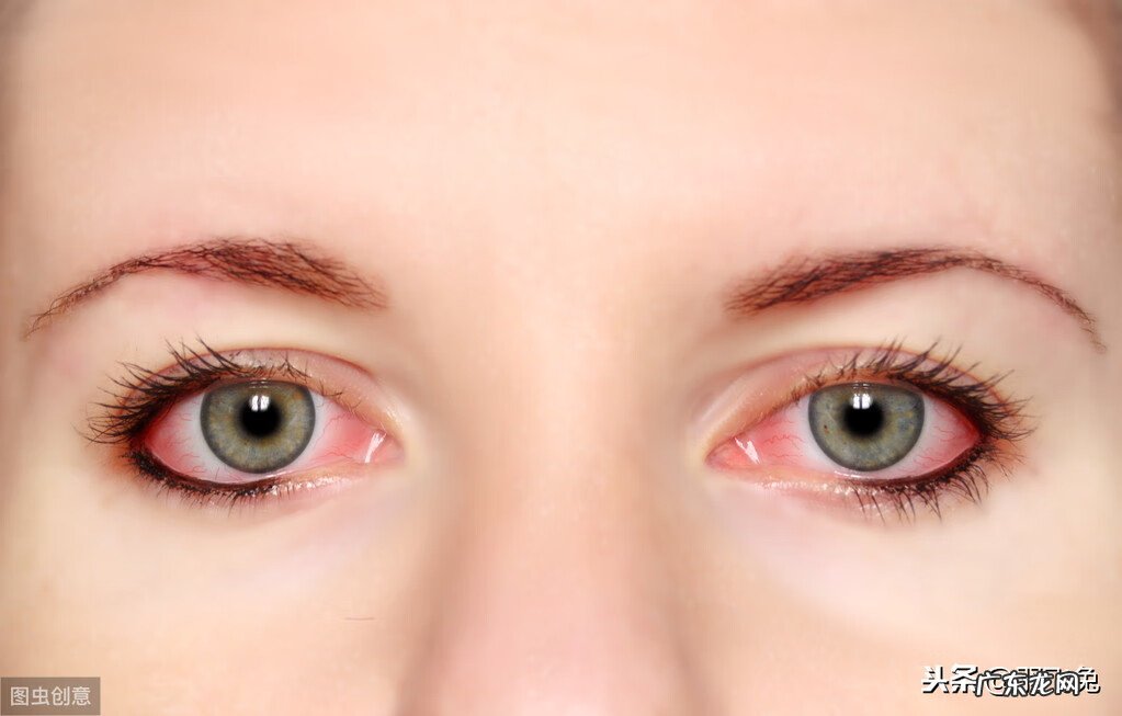 脸上突然长红血丝 脸上突然有了红血丝