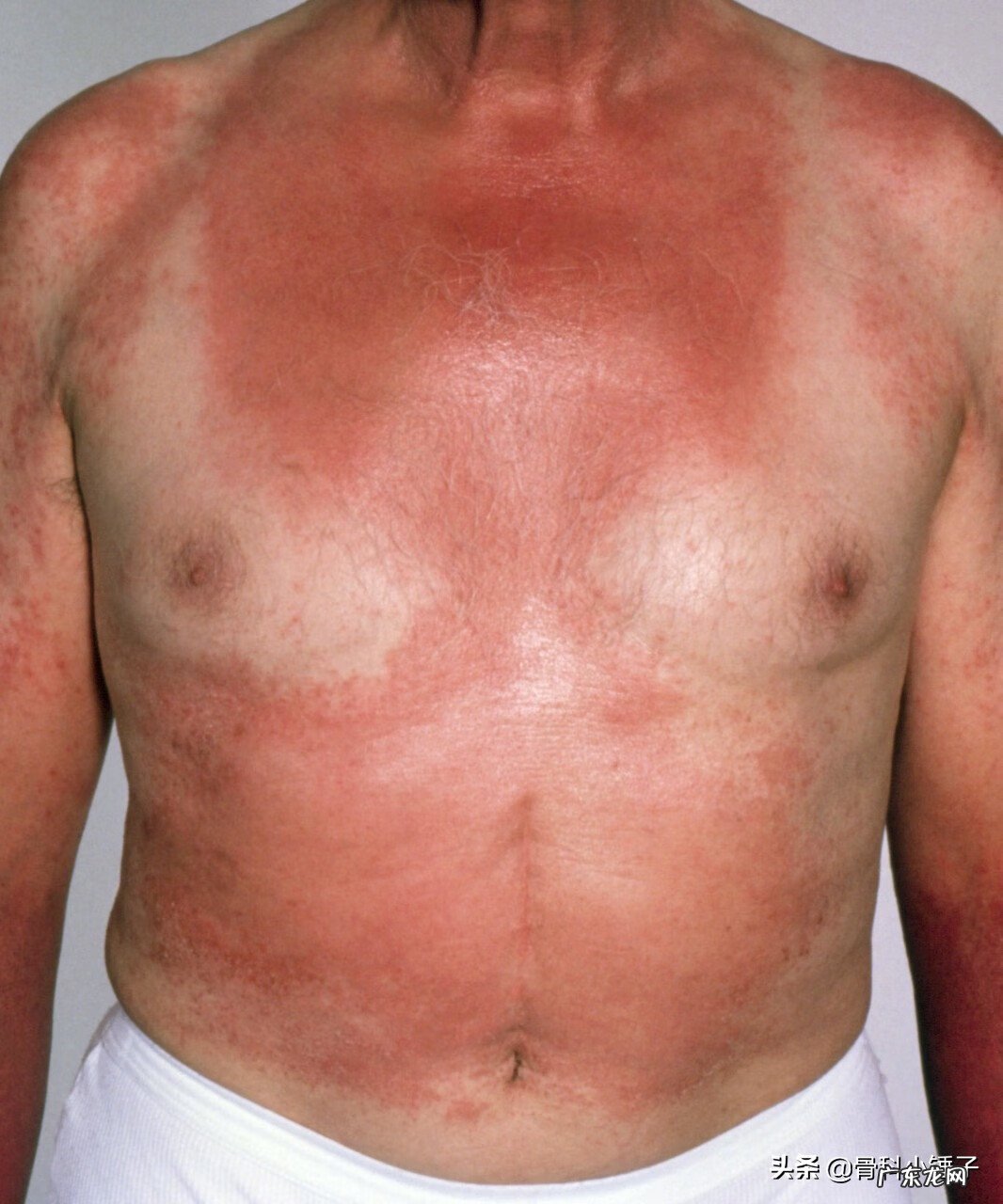 顽固性痒疹怎么治 痒疹最佳治疗方法