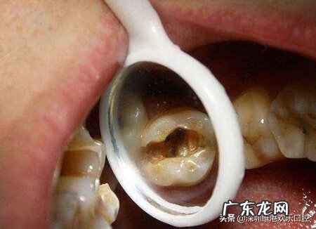 根管治疗后一天牙特别疼 根管治疗后牙疼怎么办