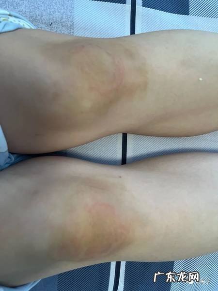 外用藿香正气水对症治湿疹医案分享