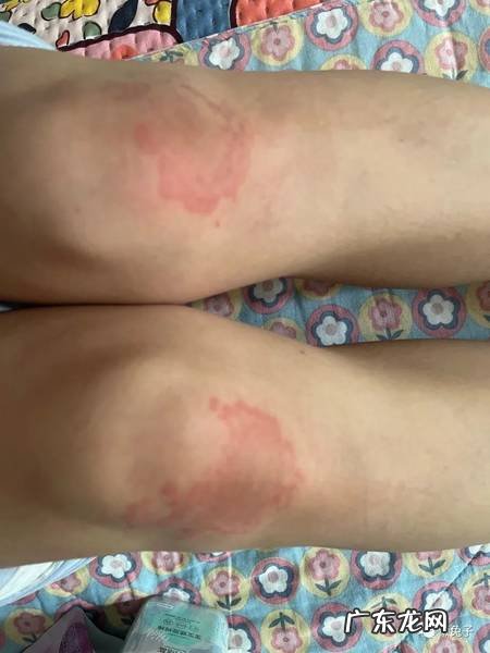 外用藿香正气水对症治湿疹医案分享