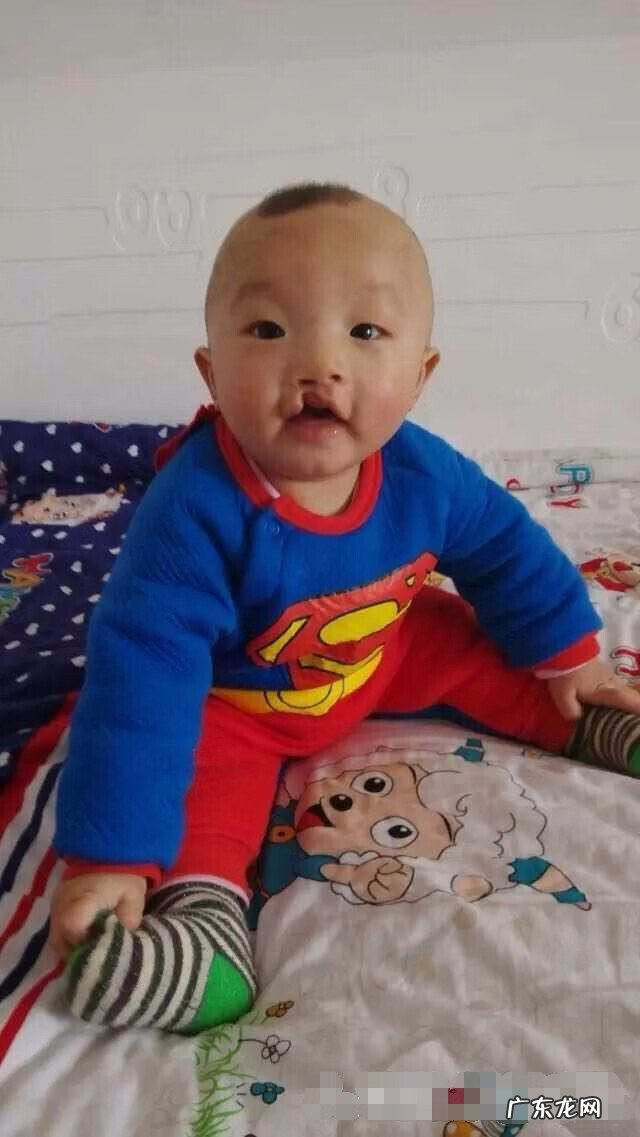 唇腭裂治疗费用 治疗兔唇的费用大概是多少