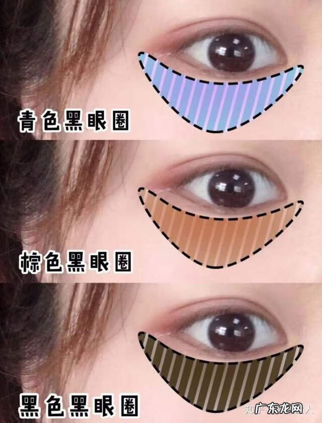 黑眼圈严重怎么快速消除 黑眼圈怎么快速消除的方法