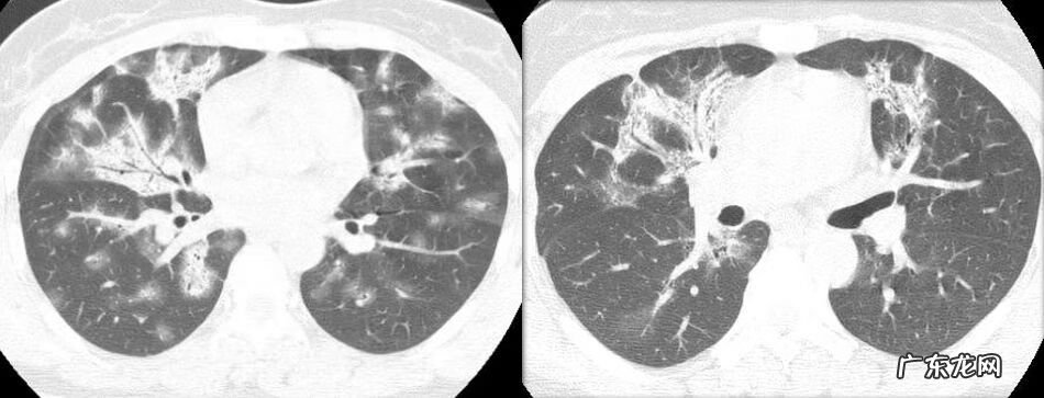 新冠肺炎事件 非典型肺炎