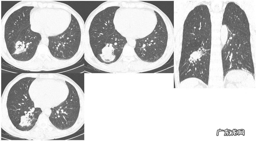 新冠肺炎事件 非典型肺炎