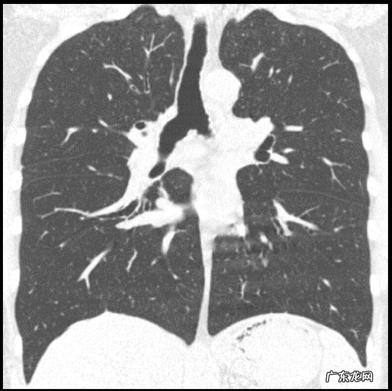 新冠肺炎事件 非典型肺炎