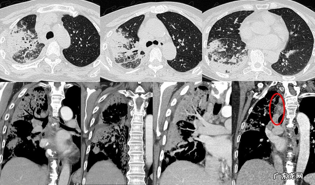新冠肺炎事件 非典型肺炎