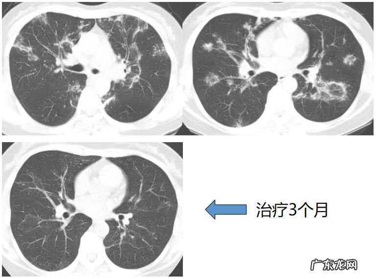 新冠肺炎事件 非典型肺炎