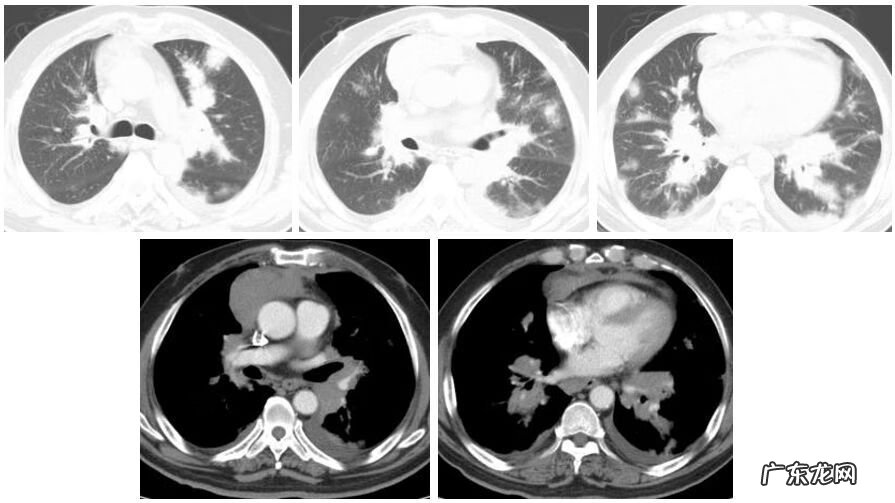 新冠肺炎事件 非典型肺炎