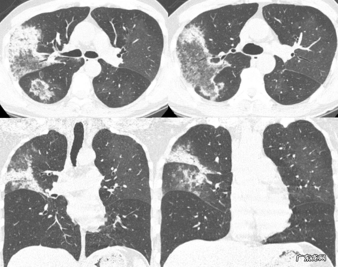 新冠肺炎事件 非典型肺炎