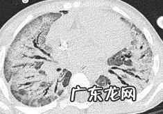 新冠肺炎事件 非典型肺炎