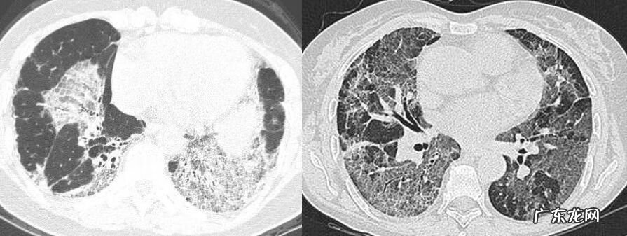 新冠肺炎事件 非典型肺炎