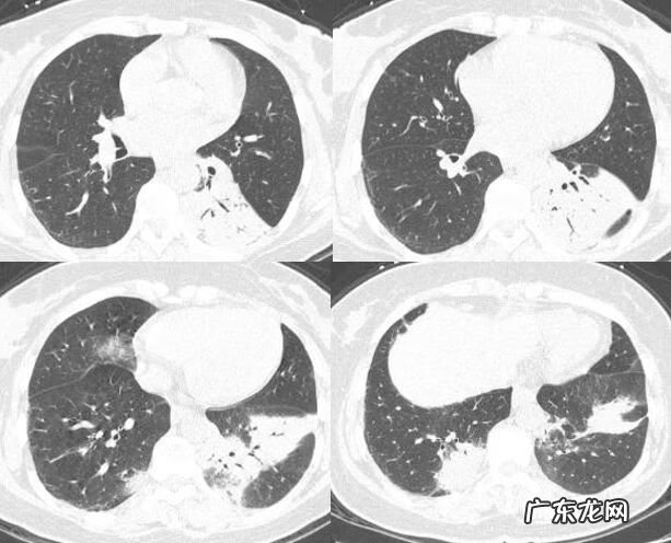新冠肺炎事件 非典型肺炎