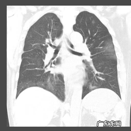新冠肺炎事件 非典型肺炎