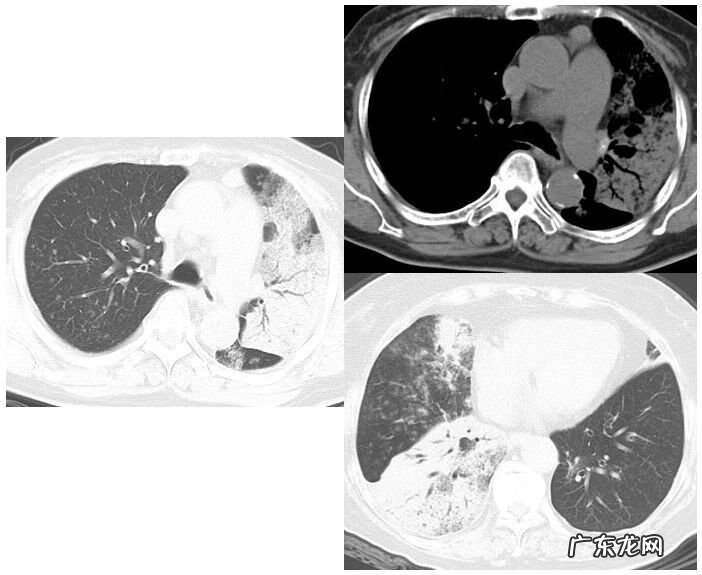 新冠肺炎事件 非典型肺炎