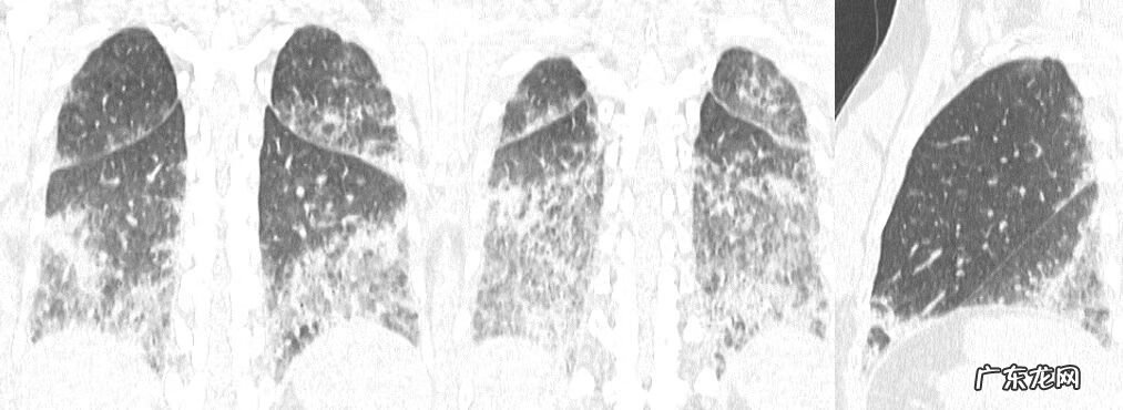 新冠肺炎事件 非典型肺炎