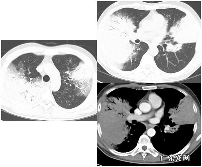 新冠肺炎事件 非典型肺炎