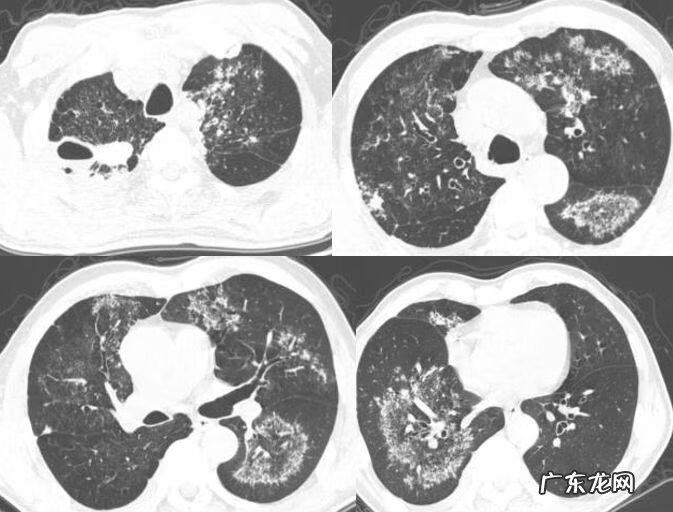 新冠肺炎事件 非典型肺炎