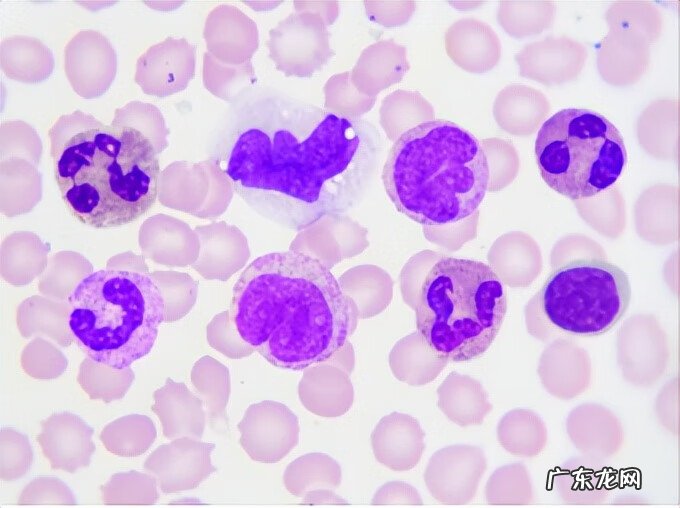 白细胞计数严重偏高 白细胞计数偏高是什么意思