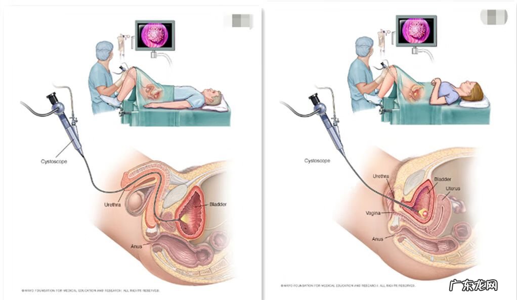尿血是什么原因造成的 尿血怎么回事儿