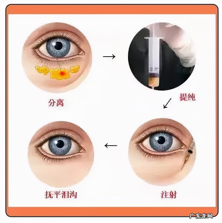 怎么去眼袋如何去眼袋 怎么才能去眼袋呢