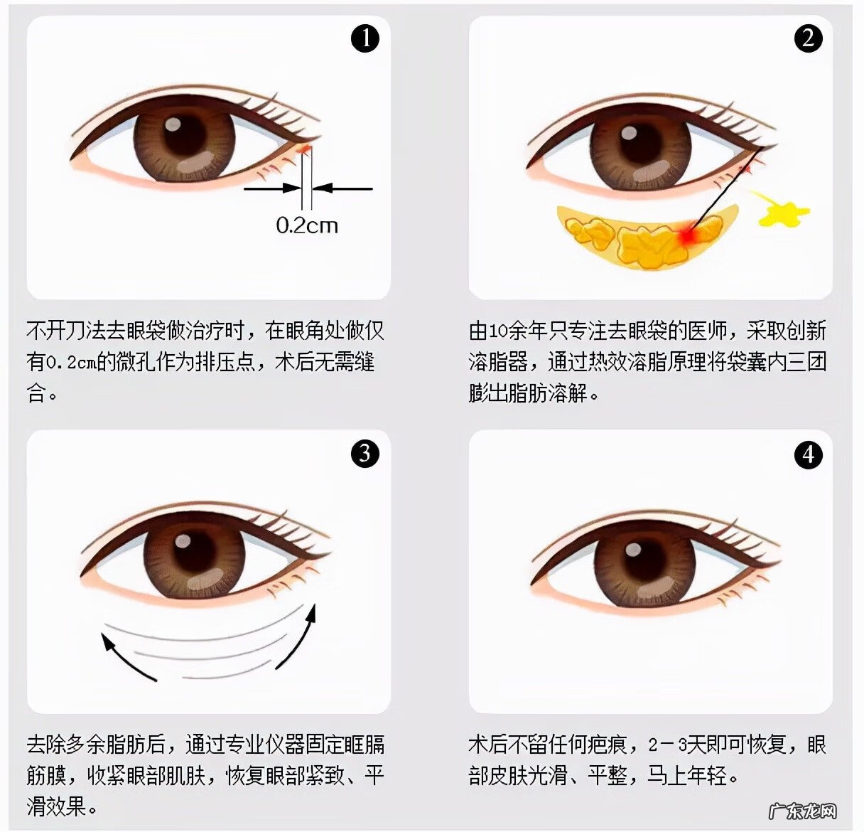 怎么去眼袋如何去眼袋 怎么才能去眼袋呢