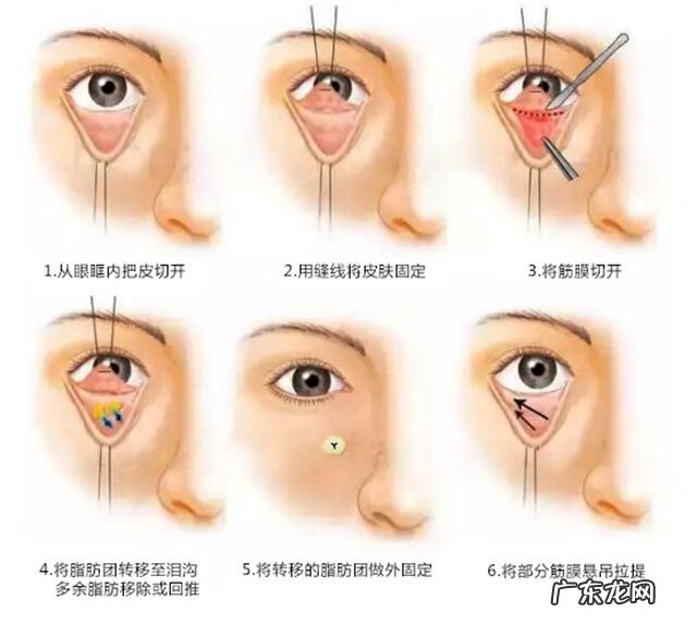 怎么去眼袋如何去眼袋 怎么才能去眼袋呢