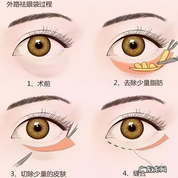 怎么去眼袋如何去眼袋 怎么才能去眼袋呢