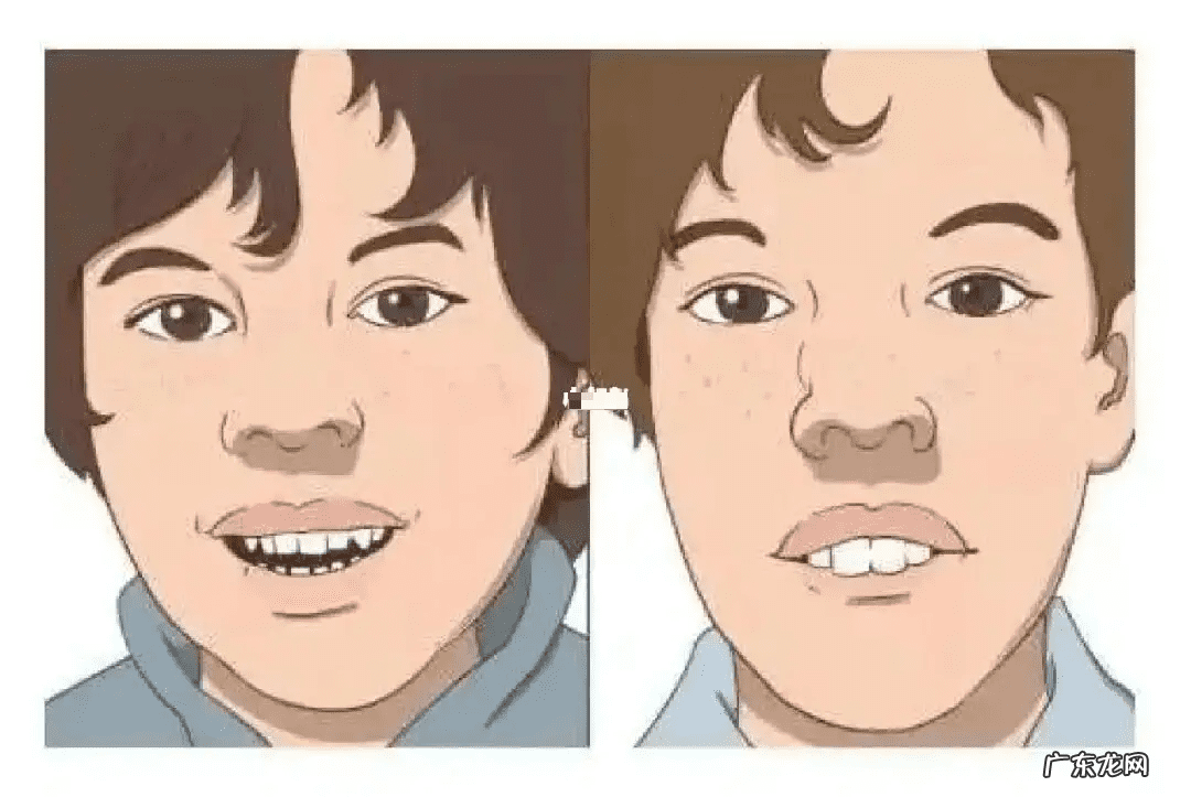 儿童腺样体肥大怎么引起的 鼻子腺体肥大是什么症状小孩怎么治疗