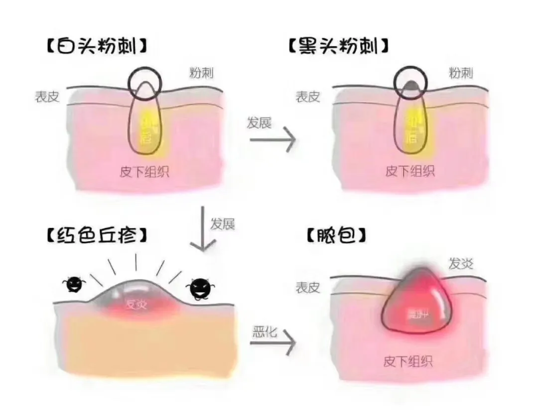 那种专业祛痘的可信吗 祛痘要学什么专业