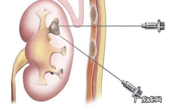 做穿刺是意味着什么病 穿刺是什么意思