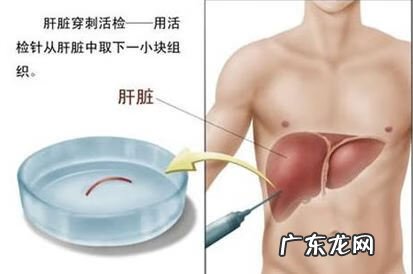 做穿刺是意味着什么病 穿刺是什么意思
