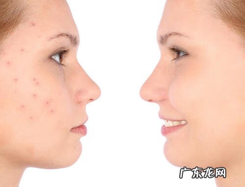 面部痤疮粉刺 痤疮粉刺有什么区别