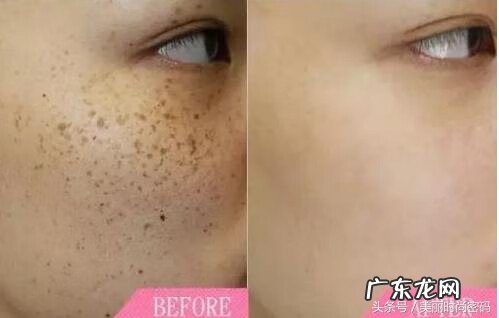 用药祛斑有副作用吗 医美祛斑副作用
