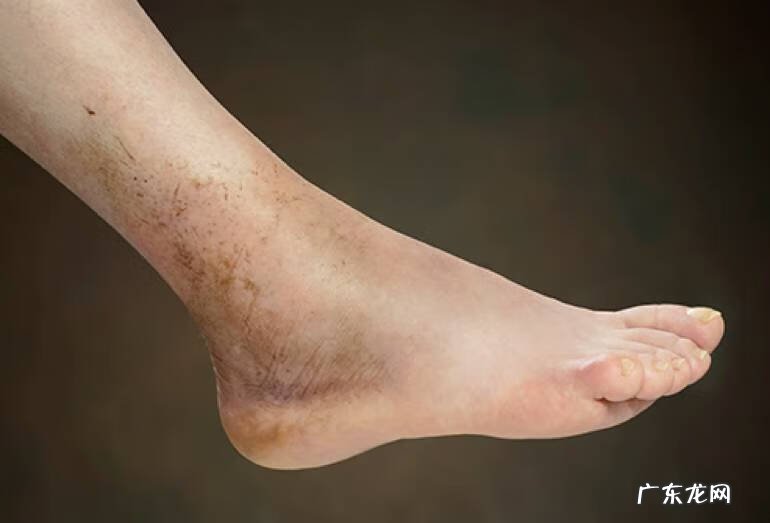 脚肿是什么原因造成 脚肿是什么原因引起的?