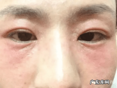 激素依赖性皮炎可以根治吗 激素依赖性皮炎图片