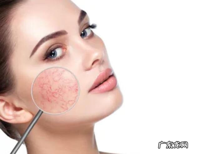 怎么消除脸上红血丝 消除脸上红血丝的方法