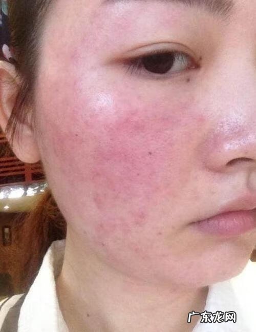 怎么消除脸上红血丝 消除脸上红血丝的方法