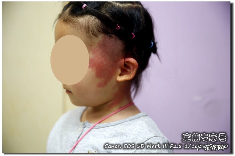 面部长红斑是怎么回事 什么是面部红斑