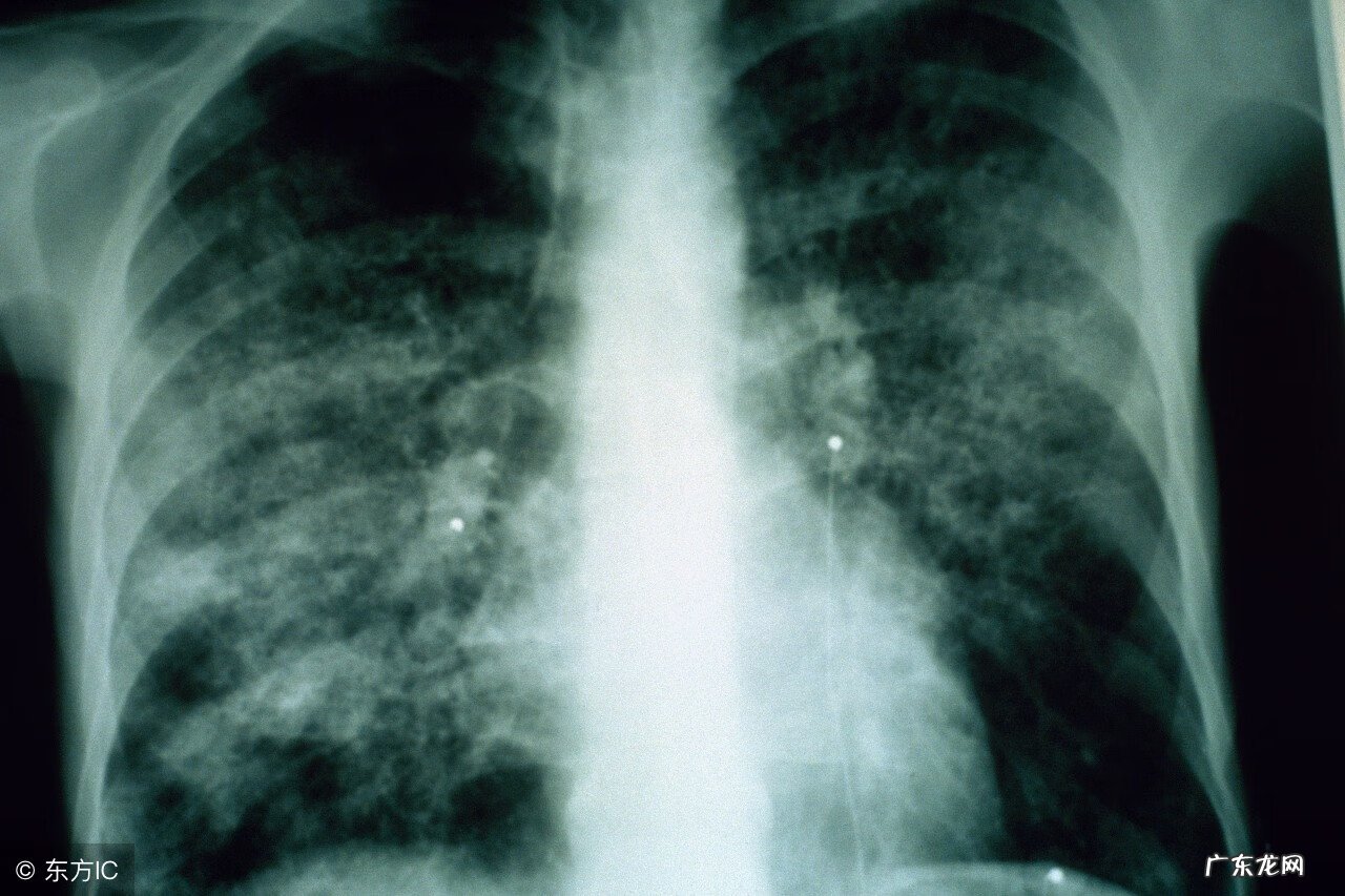 肺炎支原体性肺炎 肺炎支原体肺炎