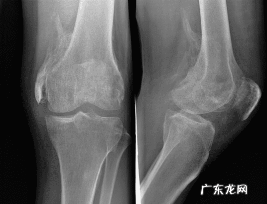 后背脊椎骨长了个疙瘩 脊椎骨长个包风水疙瘩