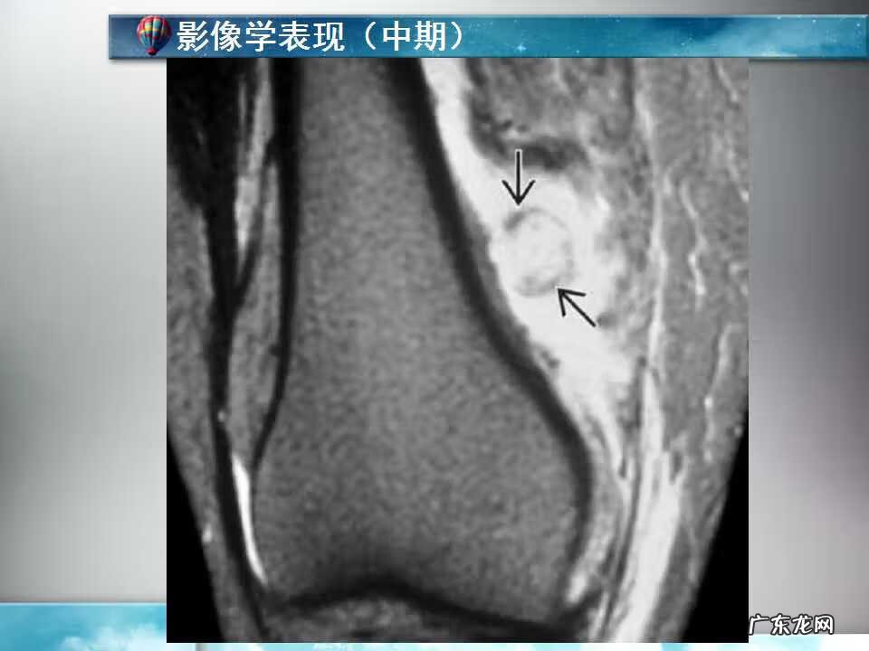 后背脊椎骨长了个疙瘩 脊椎骨长个包风水疙瘩