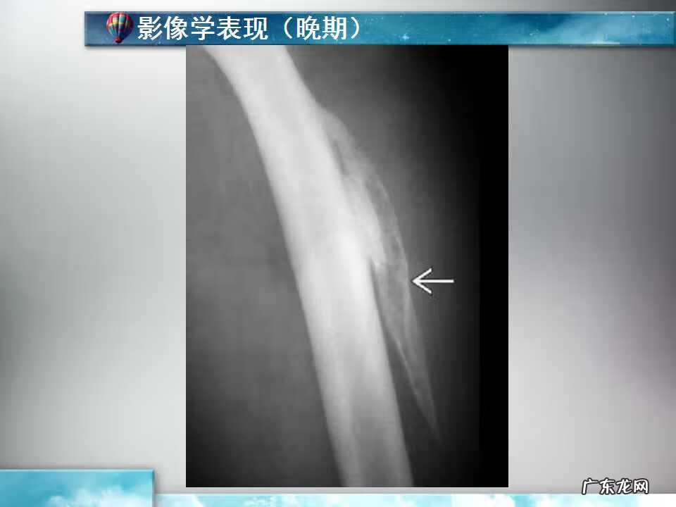 后背脊椎骨长了个疙瘩 脊椎骨长个包风水疙瘩