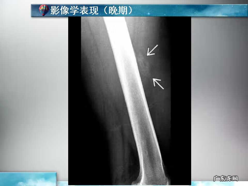 后背脊椎骨长了个疙瘩 脊椎骨长个包风水疙瘩